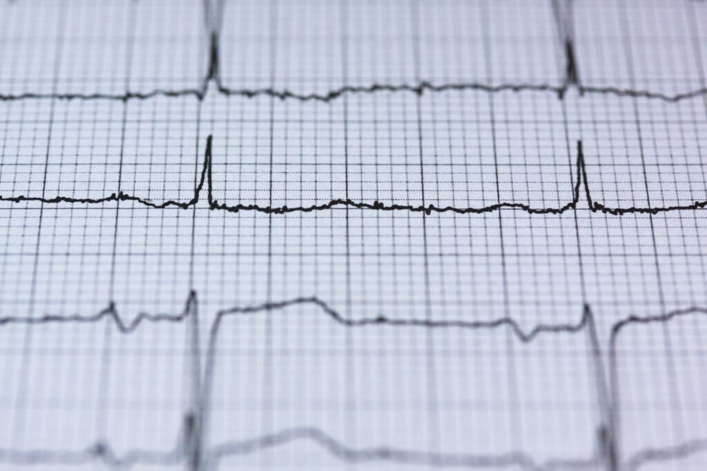 EKG-Ausdruck